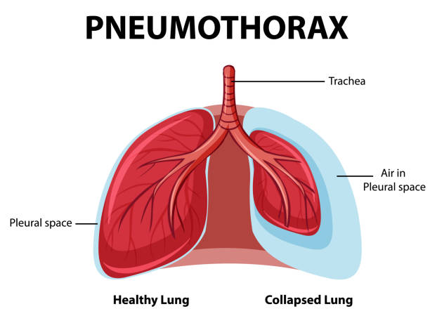 Pneumothorax diagram with collapsed lung and healthy lung Pneumothorax diagram with collapsed lung and healthy lung illustration Collapsed Lung stock illustrations