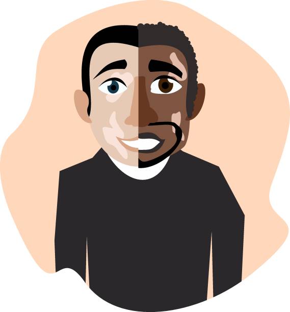 istock The face of a multinational character with vitiligo skin disease. 1345976257