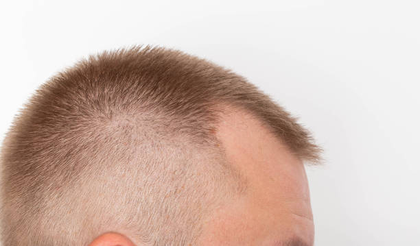 bald patches on the head of a young man. the concept of the increased hormone dihydrotestosterone. weakening of hair follicles - completely bald fotos imagens e fotografias de stock