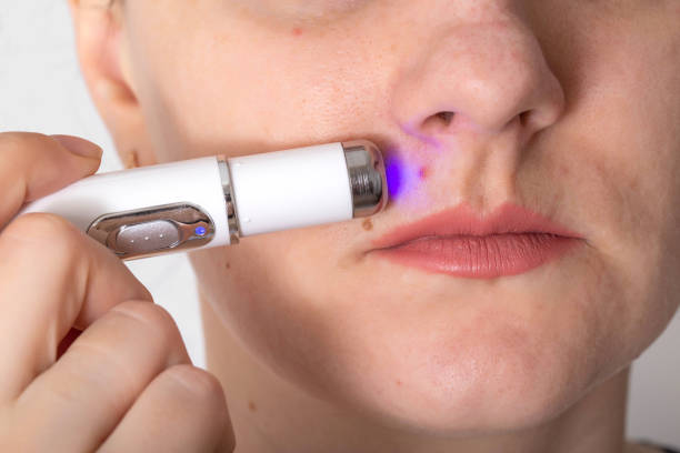 Girl treats inflamed red acne on the skin of the face with a laser cosmetic pen, cosmetic procedure. Macro Girl treats inflamed red acne on the skin of the face with a laser cosmetic pen, cosmetic procedure. Dermatologist laser pen stock pictures, royalty-free photos & images