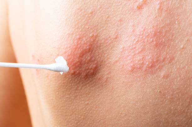 cotton swab treatment of skin rash. Shingles, varicella-zoster virus. skin rash and blisters on body. Skin infected Herpes zoster virus. Herpes Virus on body. urticaria rash. atopic dermatitis cotton swab treatment of skin rash. Shingles, varicella-zoster virus. skin rash and blisters on body. Skin infected Herpes zoster virus. Herpes Virus on body. urticaria rash. atopic dermatitis shingles rash stock pictures, royalty-free photos & images