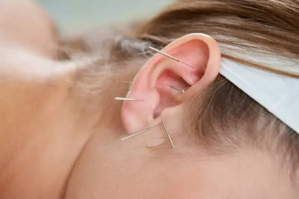 Beautiful young woman relaxing on a bed having acupuncture treatment with needles in and around her ear. Alternative Therapy concept