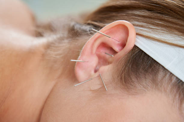 beautiful woman relaxing on a bed having acupuncture treatment with needles in and around her ear. alternative therapy concept - acupuncturist imagens e fotografias de stock