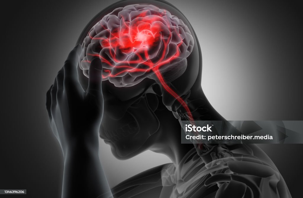 Brain stroke - conceptual artwork - 3d illustration Man with heavy headache or brain stroke - conceptual artwork - 3d illustration - Gray scale Image Brain Damage Stock Photo