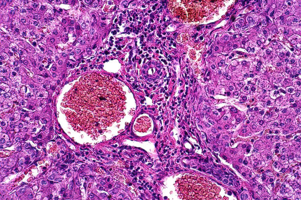 microscopio de luz de la degeneración parenquimatosa y grasa de la patología hepática. técnica de tinción de hematoxilina y eosina para tejido humano. - laboratory healthcare and medicine cancer drug histology fotografías e imágenes de stock