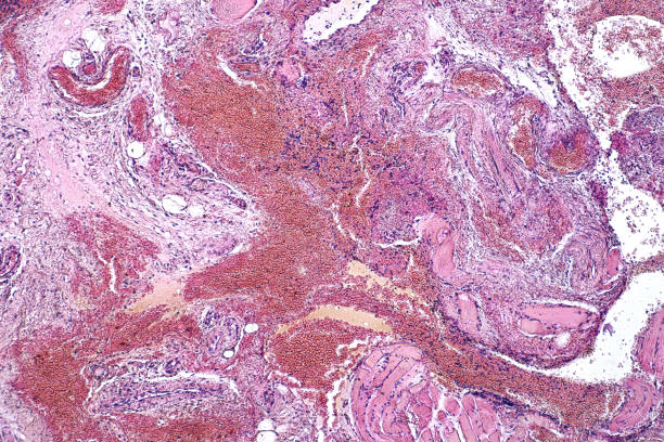 istock Light microscope Tonsillitis pathology. Haematoxylin and eosin staining technique for human tissue. 1346440851