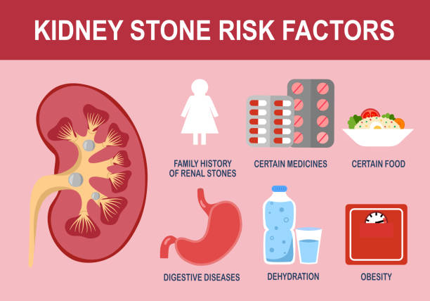 ilustrações, clipart, desenhos animados e ícones de fatores de risco de pedra nos rins ilustração vetorial. - kidney stone