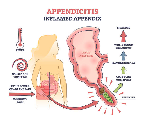 Collapsed Appendix 4,600+ Appendicitis Stock Photos, Pictures & Royalty-Free Images - iStock