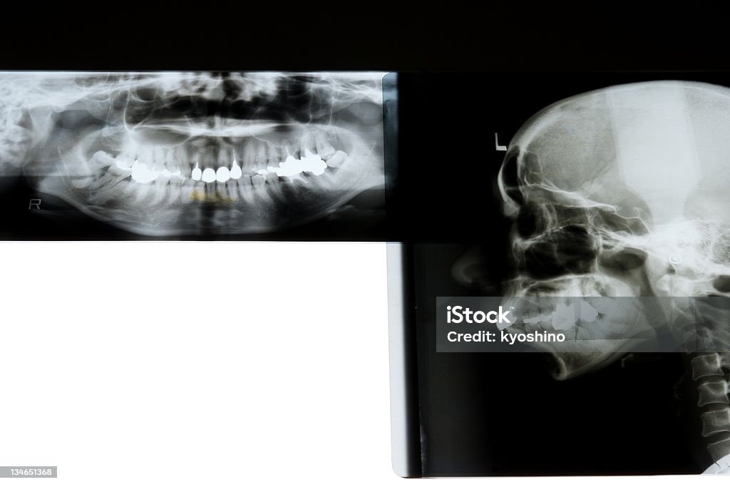 歯科 X 線 - X線撮影のロイヤリティフリーストックフォト