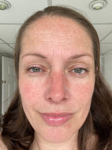istock woman with melasma pigment on face 1346527530