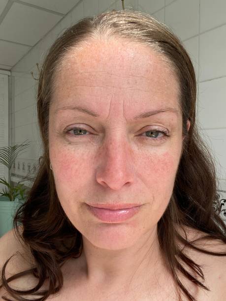 istock woman with melasma pigment on face 1346527532