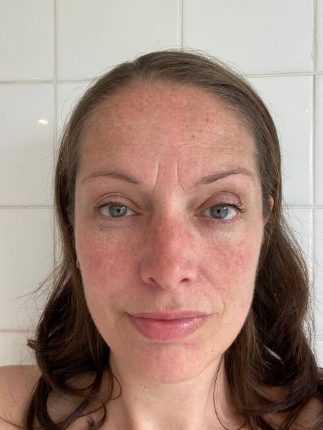 istock woman with melasma pigment on face 1346527534