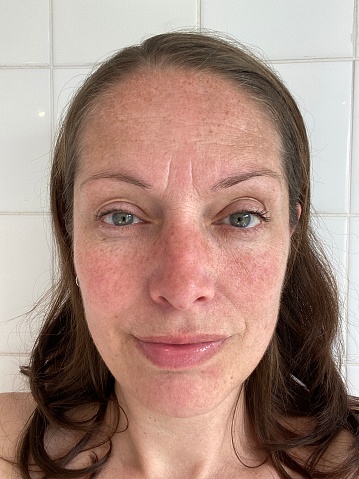 mujer con pigmento de melasma en la cara photo