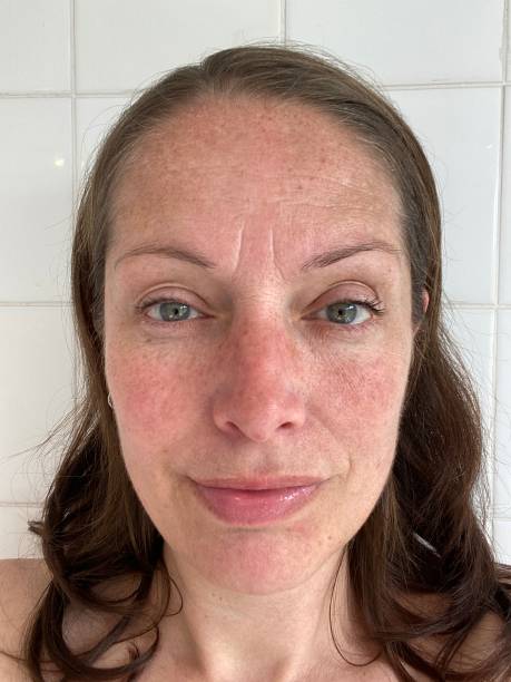 istock woman with melasma pigment on face 1346527543