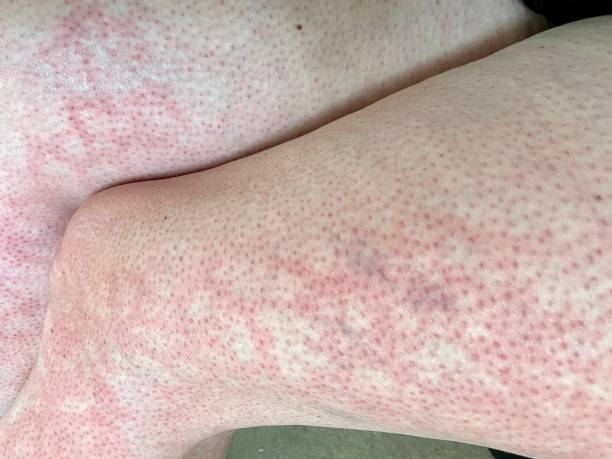 hives heat rash EAI Erythema ab igne heat reaction on knee close-up reference picture of blotchy red skin stock photo