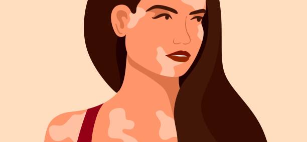 vitiligo ist eine junge frau mit hautproblemen. hautkrankheiten. das konzept des welt-vitiligo-tages. verschiedene hautfarben weiblicher charaktere. für einen blog, artikel, banner, magazin. - skin singer stock-grafiken, -clipart, -cartoons und -symbole