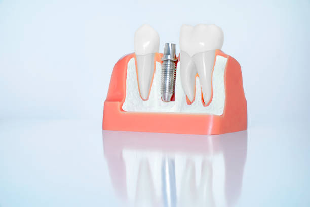 istock Dental implant model on white background 1346677975