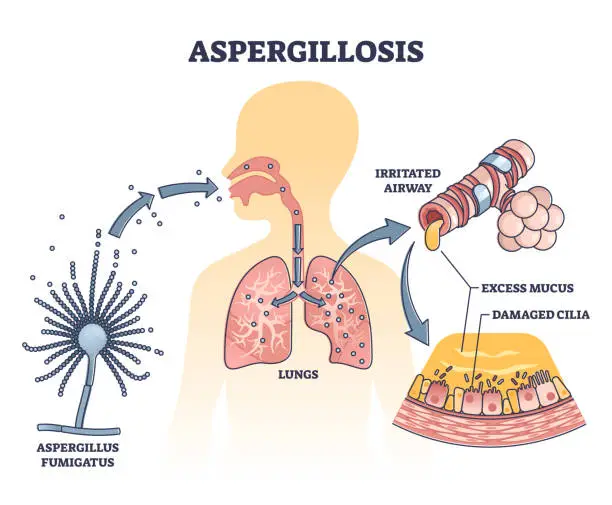 Vector illustration of Aspergillosis lung infection caused by Aspergillus, vector outline diagram