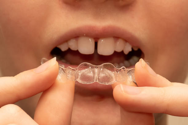 Close up of a girl holding put on invisible braces. Orthodontic dental braces teeth straighteners. Gap between front teeth Close up of a girl holding put on invisible braces. Orthodontic dental braces teeth straighteners treatment. Gap between front teeth. gap toothed photos stock pictures, royalty-free photos & images