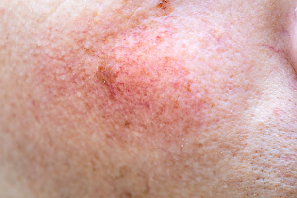 Red face, skin discoloration, broken blood vessels, health problems