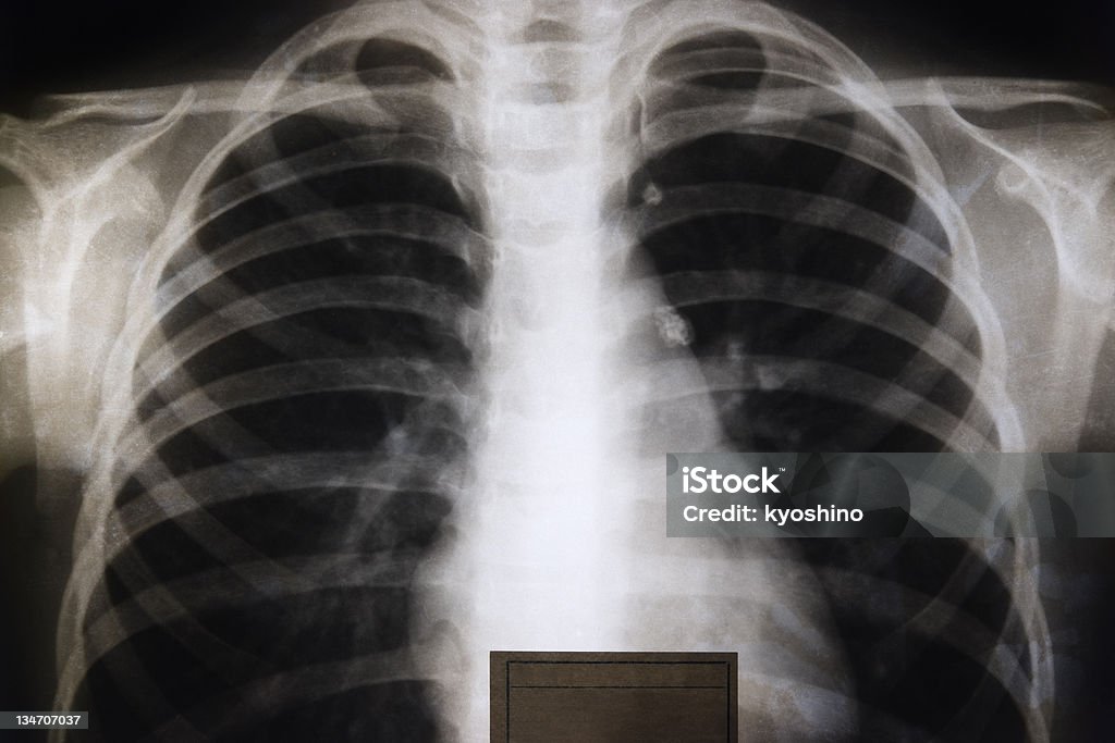 古い X 線画像の胸 - X線撮影のロイヤリティフリーストックフォト