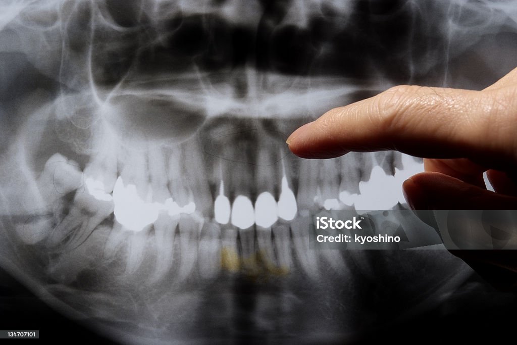 歯科 X 線 - X線撮影のロイヤリティフリーストックフォト
