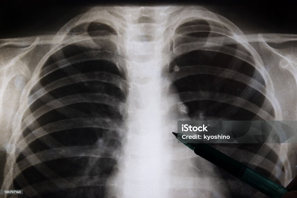X 線画像の胸 - X線撮影のロイヤリティフリーストックフォト