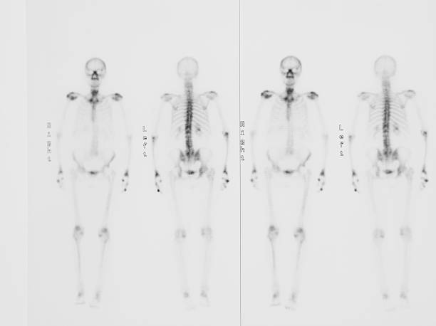 istock Gamma scan of human body...scintigraphy 134715703