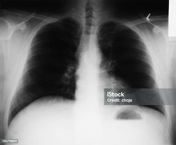 Xray Image Of Human Chest Stock Photo - Download Image Now - Aorta, Asthmatic, Black Color