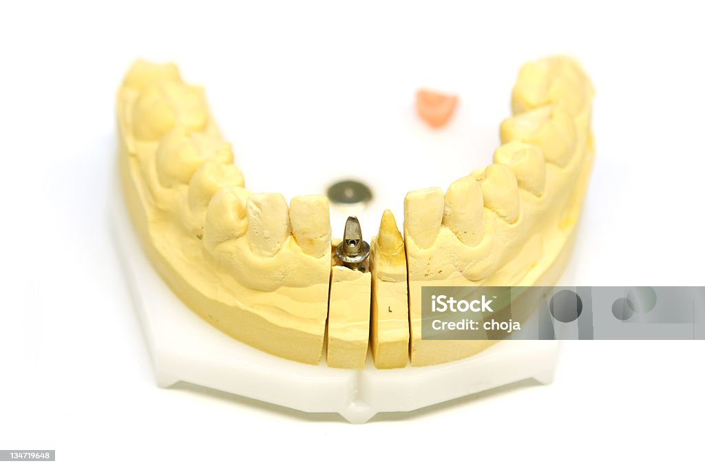 Implante dentário - Foto de stock de Amarelo royalty-free