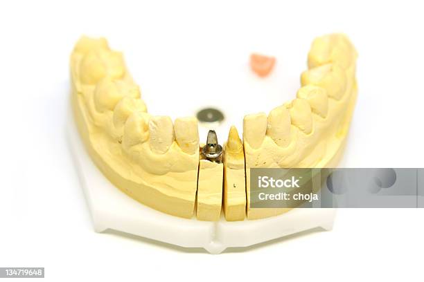 Foto de Implante Dentário e mais fotos de stock de Amarelo - Amarelo, Anatomia, Dentadura