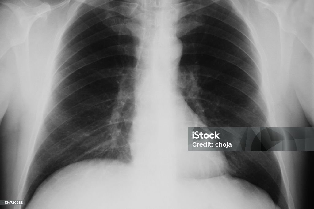 X -ray of human 胸 - X線撮影のロイヤリティフリーストックフォト