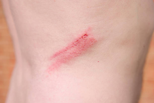 istock Grazed skin, abrasion on a man's back, UK 1347234719
