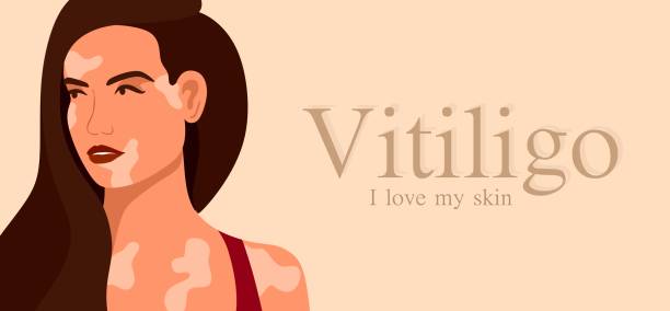 vitiligo ist eine junge frau mit hautproblemen. hautkrankheiten. das konzept des welt-vitiligo-tages. verschiedene hautfarben weiblicher charaktere. für einen blog, artikel, banner, magazin. - skin singer stock-grafiken, -clipart, -cartoons und -symbole