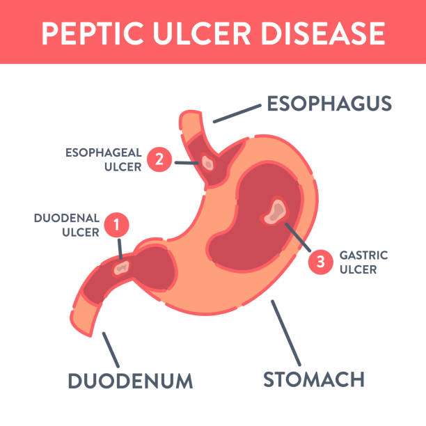 infografiki medyczne z rodzajami choroby wrzodowej żołądka - peptic ulcer stock illustrations