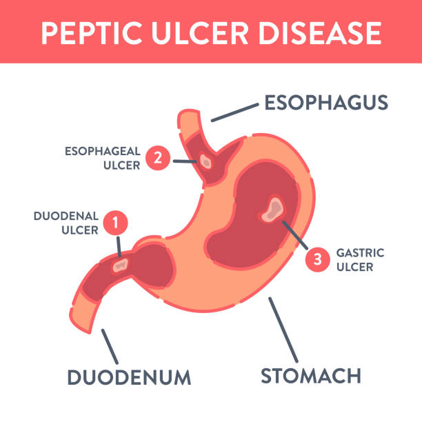 медицинская инфографика с видами язвенной бол�езни желудка - peptic ulcer stock illustrations