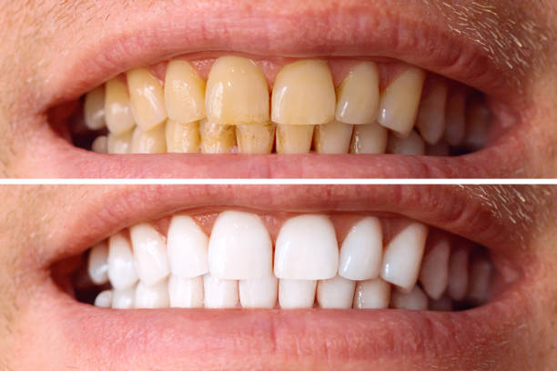 dientes antes y después del blanqueamiento. sobre fondo blanco. paciente de clínica dental. la imagen simboliza la odontología del cuidado bucal, la estomatología - blanqueamiento dental fotografías e imágenes de stock