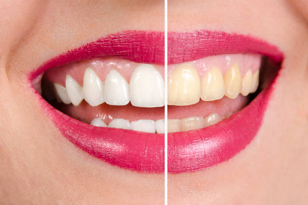 istock Before and after teeth whitening, closeup shot 1347328386