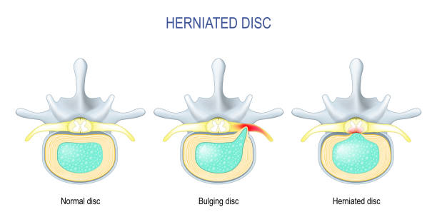 illustrations, cliparts, dessins animés et icônes de différence entre le disque bombé et la hernie discale. - full