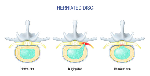 Difference Between Bulging disc and Herniated Disc. vector art illustration