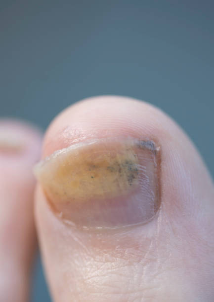 großer zehen mit pilzwachstum am zehennagel - fungus toenail human foot onychomycosis stock-fotos und bilder