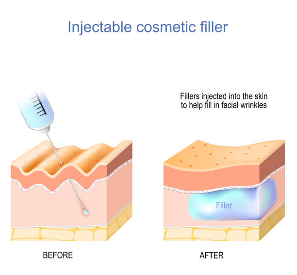 cosmetic filler injectable vector art illustration