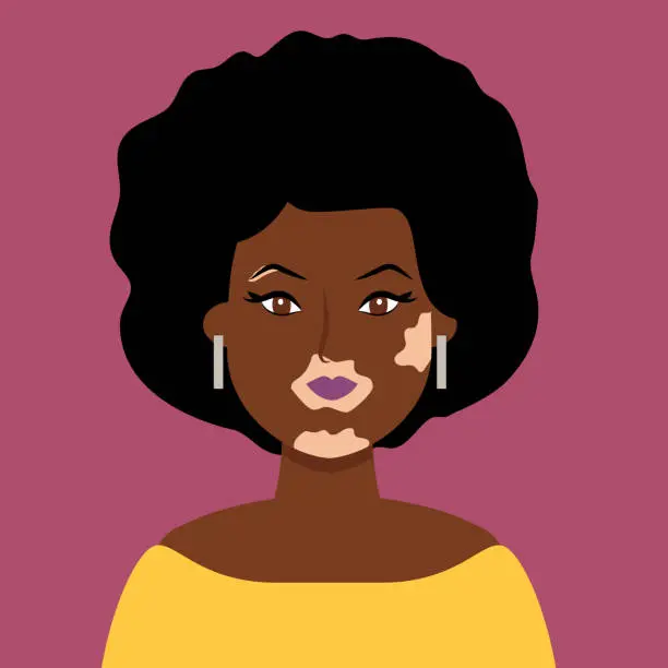 Vector illustration of African Woman with Vitiligo on dark skin, Self Love, Vector illustration in Hand Drawn flat style