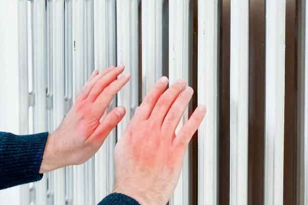 Hands suffering chilblain trying to warm up