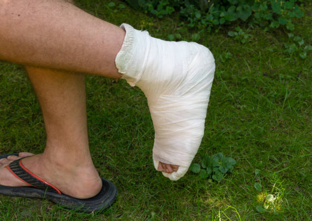 istock Man with broken leg in white plaster cast walks on green grass. Broken leg after falling from stairs. Leg turned up and broke 1347640540