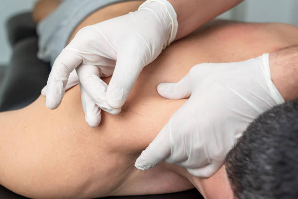 istock Physiotherapist performing acupuncture on a patient's back 1347653306