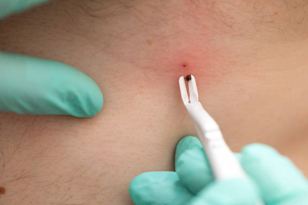 istock Removing tick from human skin 1347669791