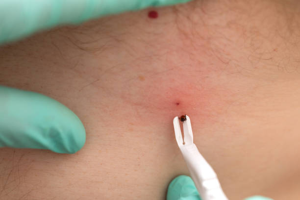 istock Removing tick from human skin 1347669833