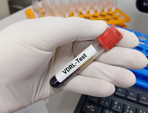 istock Biochemist or Lab Technologist holds Blood samples for VDRL ( venereal disease research laboratory) test, diagnosis for syphilis infection in the laboratory background. 1347708918