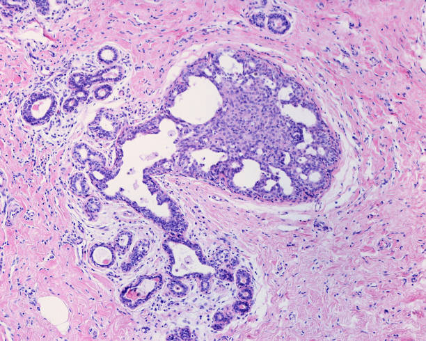 seno umano. dotto lattifero. iperplasia epiteliale - lactiferous duct foto e immagini stock